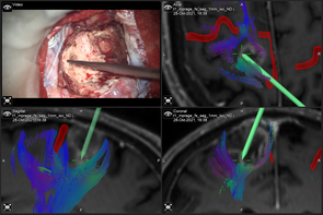 Das Bild zeigt den Einsatz von Fibertracking im neurochirurgischen OP.