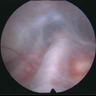 Das Foto zeigt das Kamerabild eines neuroendoskopischen Eingriffs.