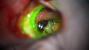 Das Bild zeigt den Blick durch das OP-Mikroskop während einer Hirn-OP unter Einsatz der Infrarot-Video-Angiographie.