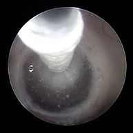 Das Foto zeigt das Kamerabild eines neuroendoskopischen Eingriffs.