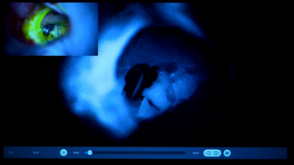 Das Bild zeigt das Verfahren der Infrarot-Video-Angiographie, das die Darstellung des Blutflusses im Gefäß während einer Hirn-OP ermöglicht.